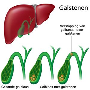 galstenen.jpg